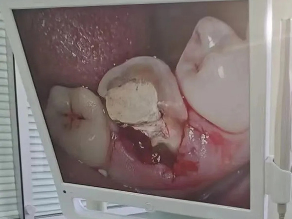 【昌华玉牙】根管不做冠，早晚是后患！患者“不做冠”后牙齿劈成了两半
