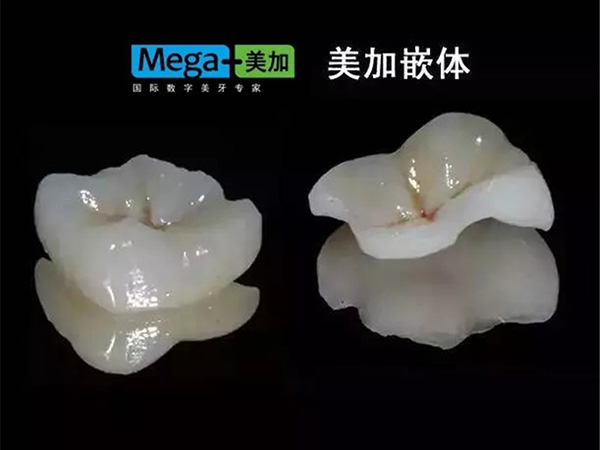 【昌华玉牙】美加案例——瓷嵌体补牙，这牙补的也太真啦！