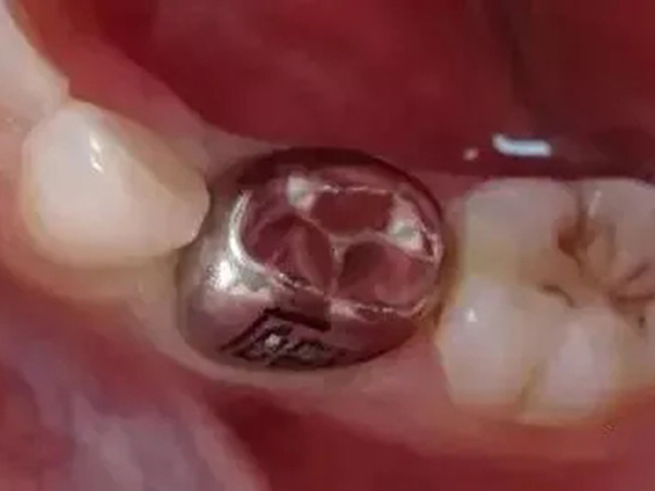 【昌华玉牙】科普：什么是预成冠？儿童乳牙的保护伞
