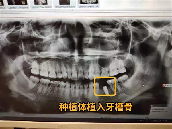 【昌华玉牙】患者日志——28岁种牙的女孩